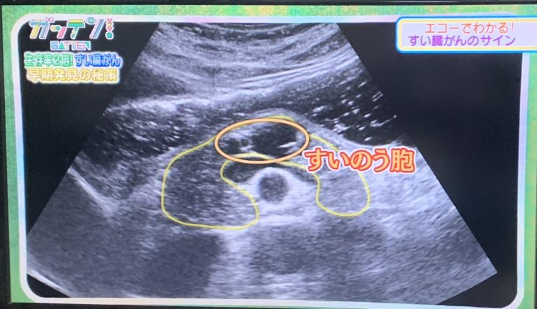 すい臓がん 超早期発見の方法とは？エコーで生存率の低いがんを克服！ガッテン！ 学ぼうネット